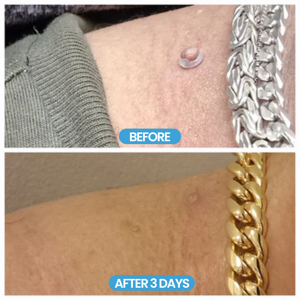 MyTag® Auto Wart Removal Kit [Clear Skin in 3 Days]